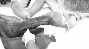 Sai lầm trong tự điều trị vết thương, nhiều người bị biến chứng hoại tử chi